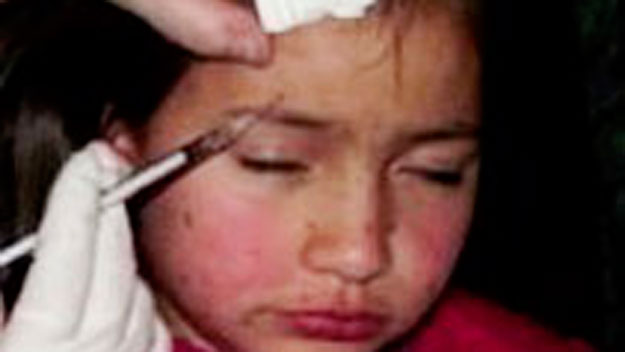 Should mother be banned from injecting daughter, 8, with Botox?