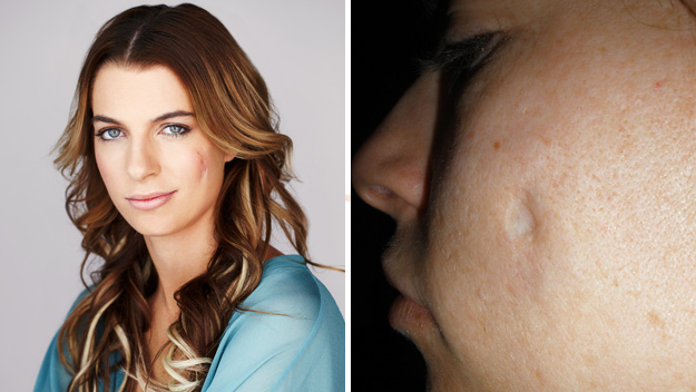 Botched cosmetic surgery gouged a hole in my face
