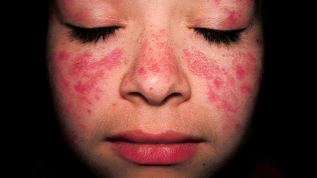 A lupus sufferer with typical facial scarring.