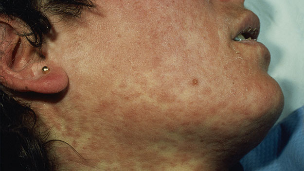 The red measles rash, stock image