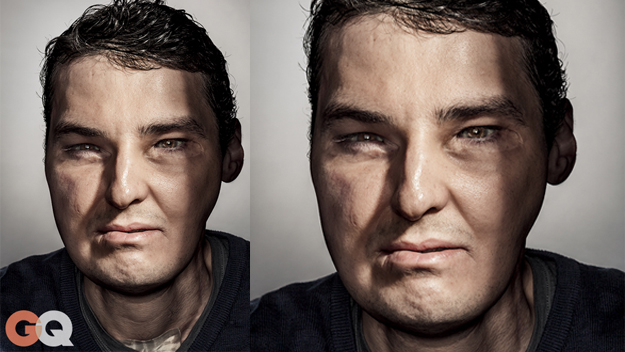 Richard Lee Norris is the recipient of the world's most expensive face transplant
