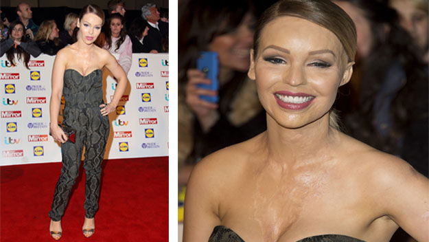 Katie Piper scars