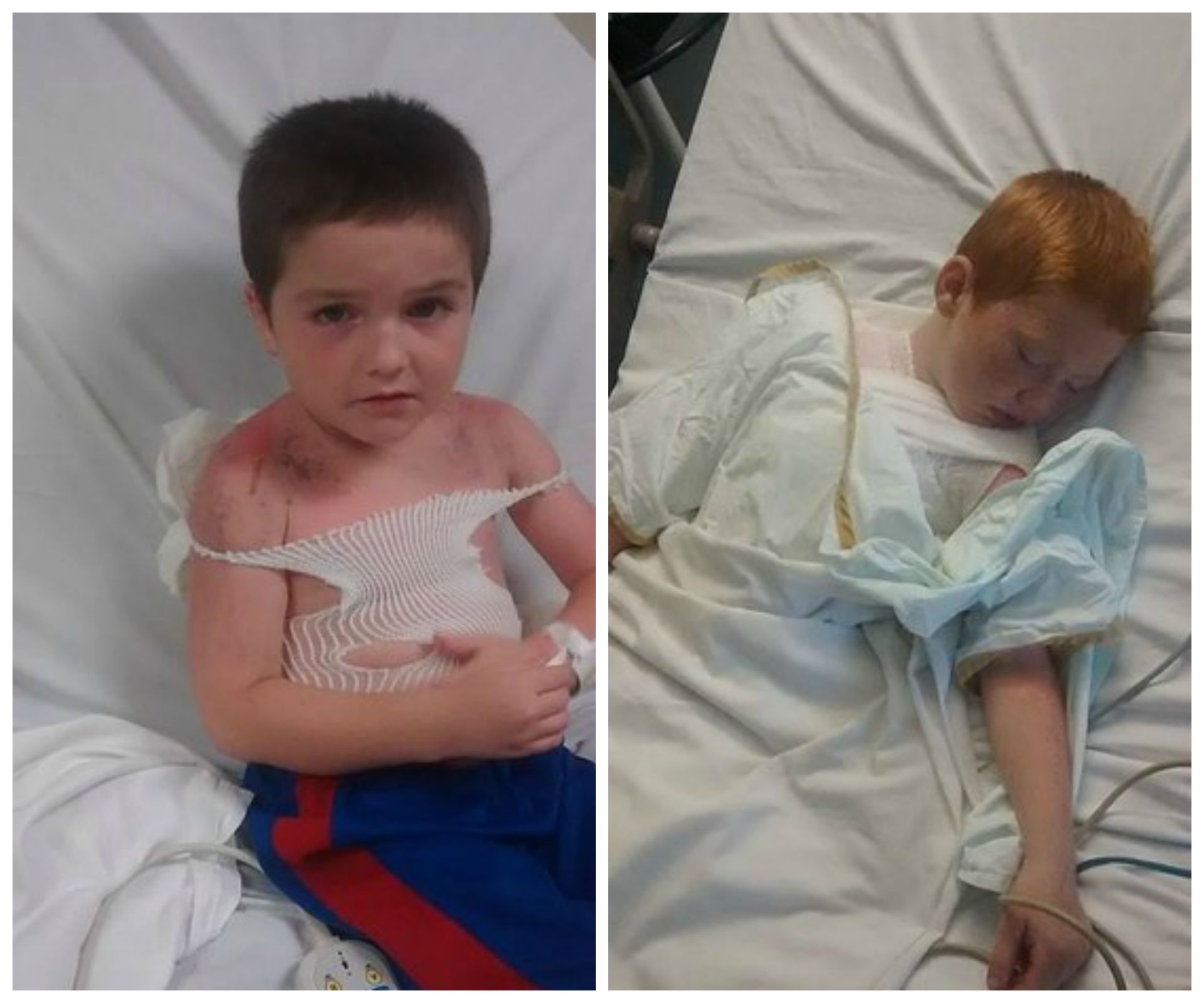 Boys suffer third degree burns at daycare