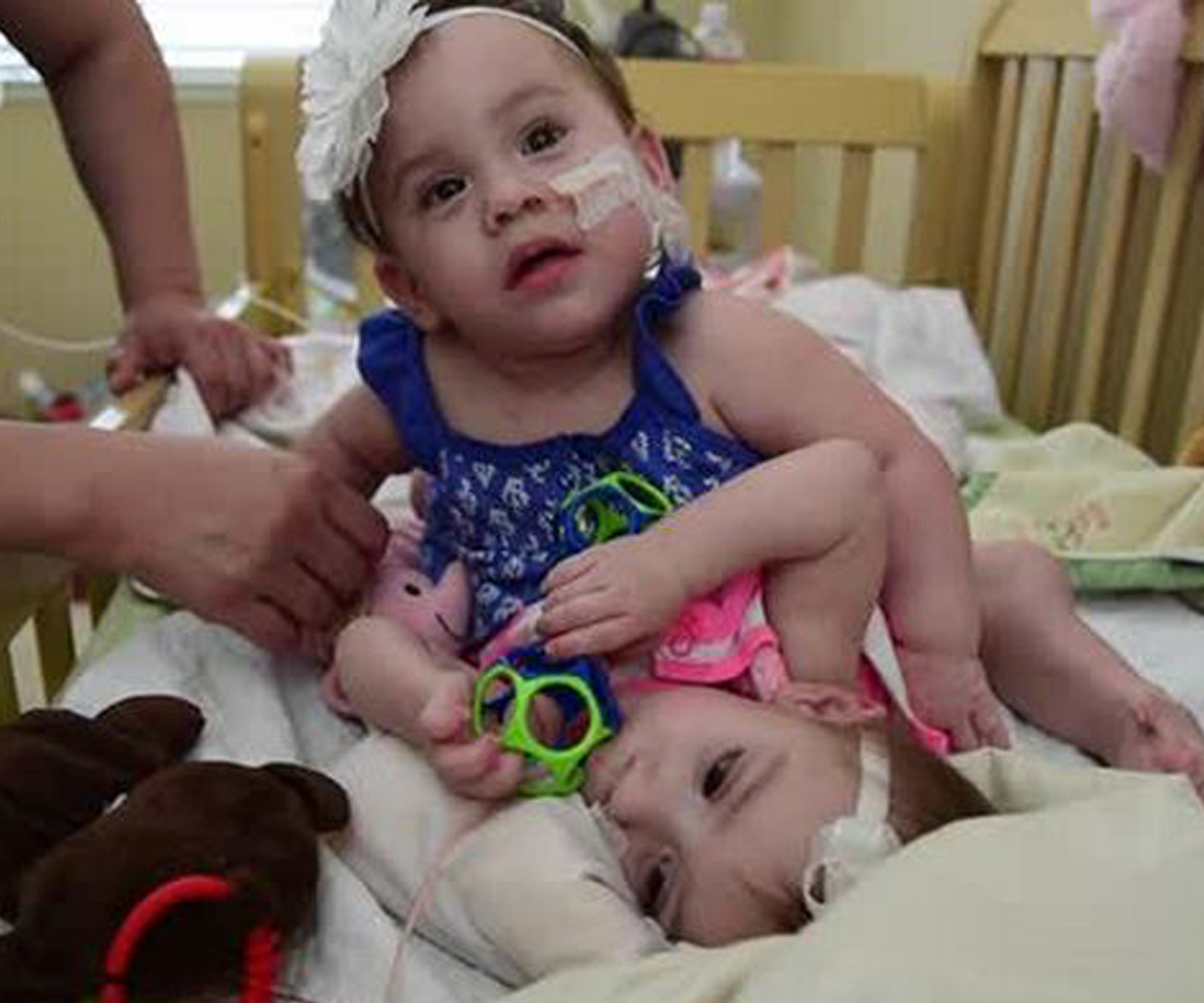 US couple prepare to separate their “perfect” conjoined twins