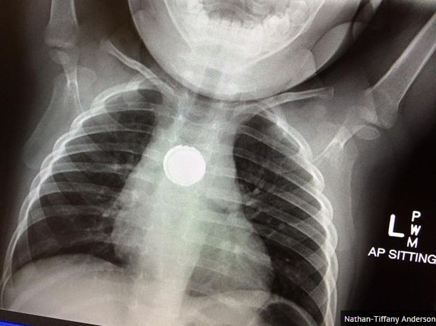 Toddler nearly dies after swallowing battery