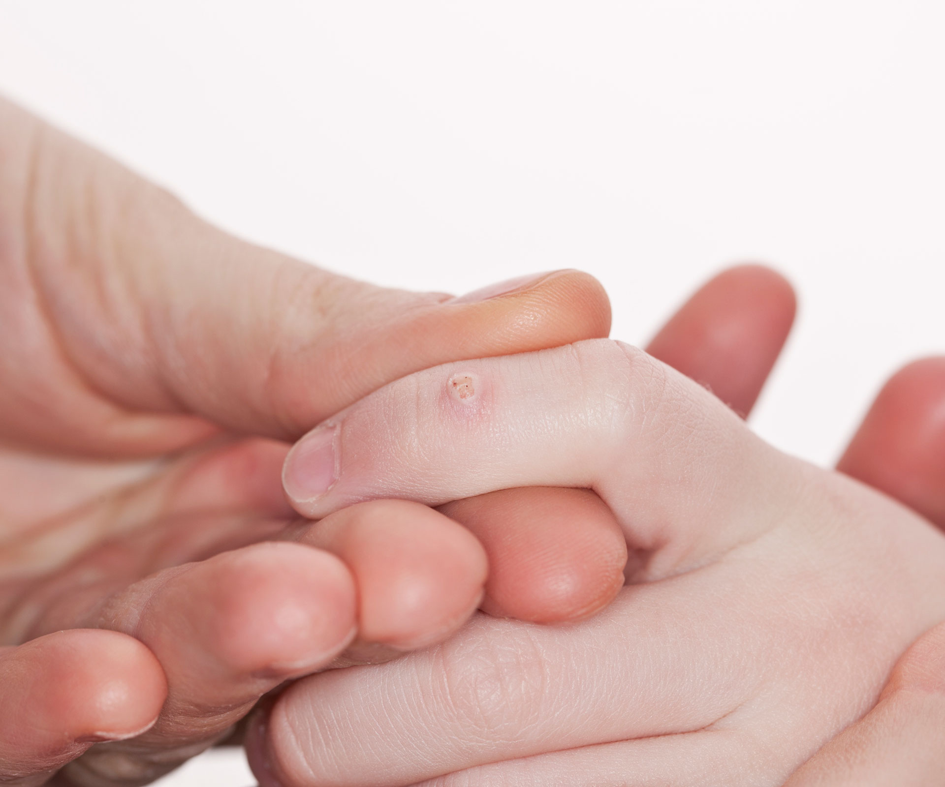 The truth about warts