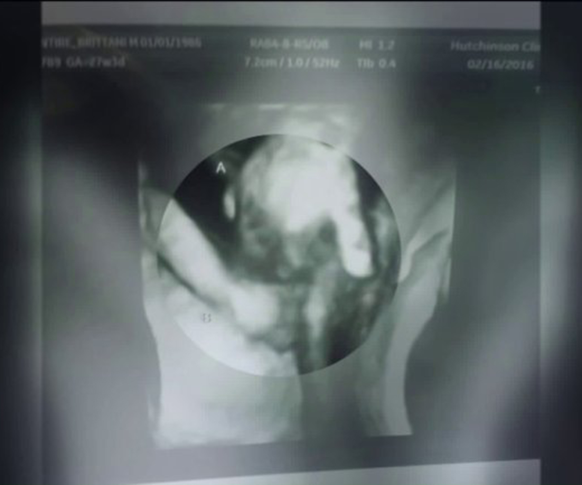 Touching sonogram shows unborn baby girl holding her dying twin brother’s hand