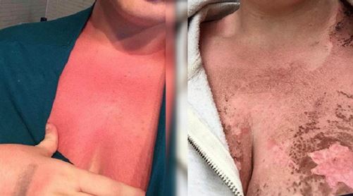 Melbourne woman burnt by sunscreen