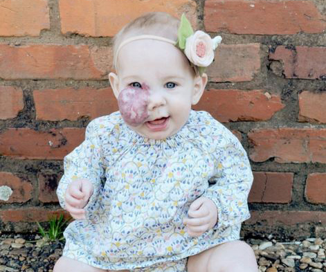 Mother’s defence of daughter’s birthmark goes viral