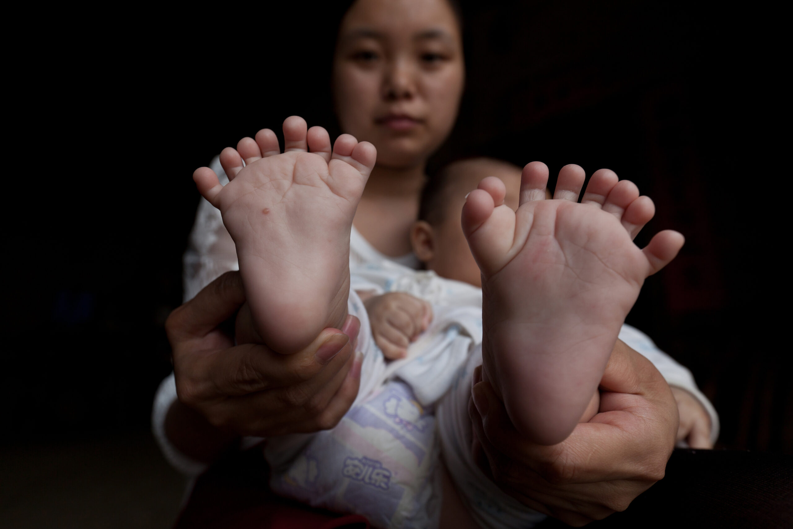Chinese baby born with 31 fingers and toes
