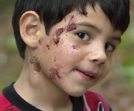 This boy’s daycare scrubbed his face until it bled