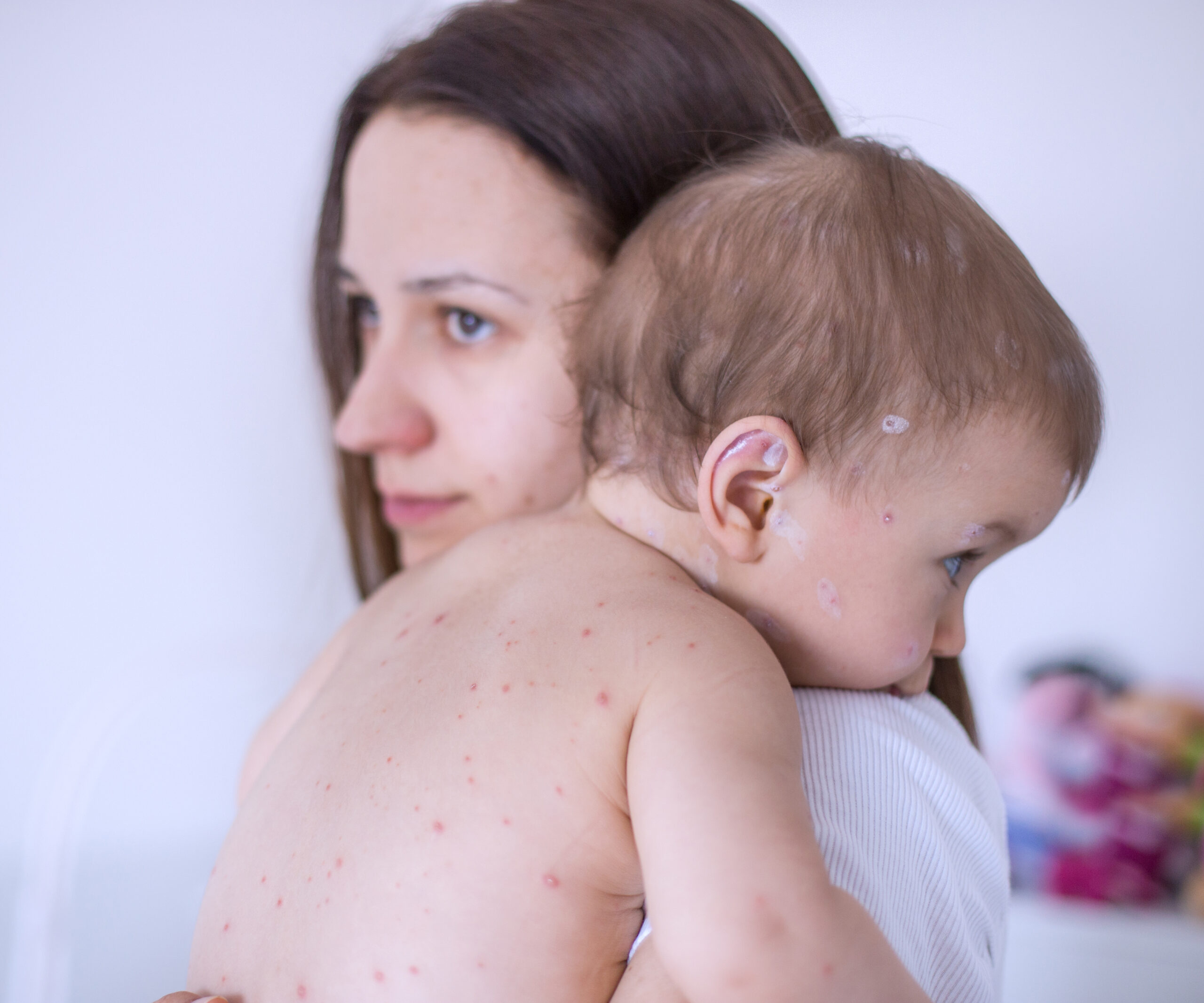 HEALTH WARNING: Measles in Melbourne
