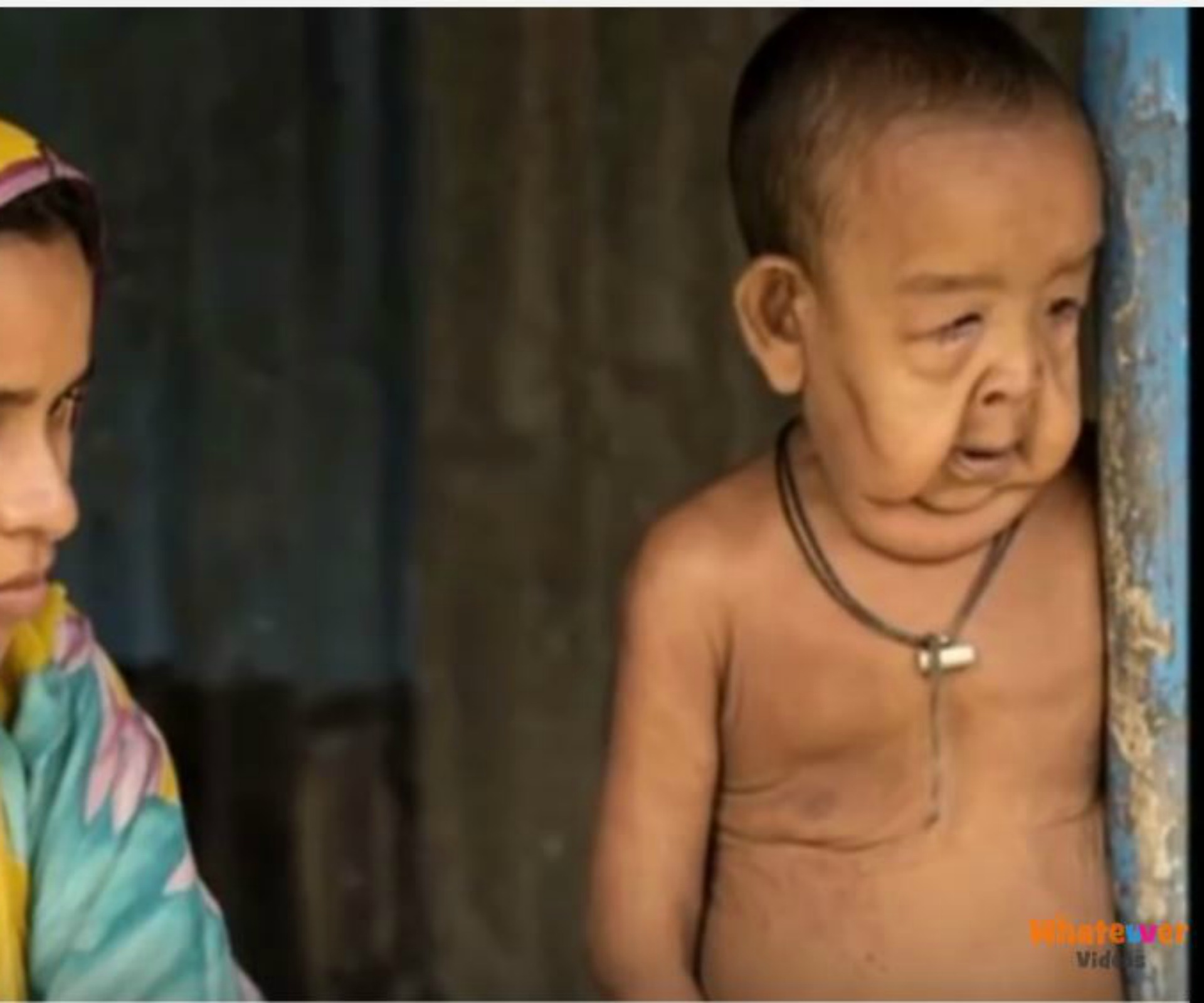 Heartbreaking tale of Bangladesh’s ‘Benjamin Button’ toddler
