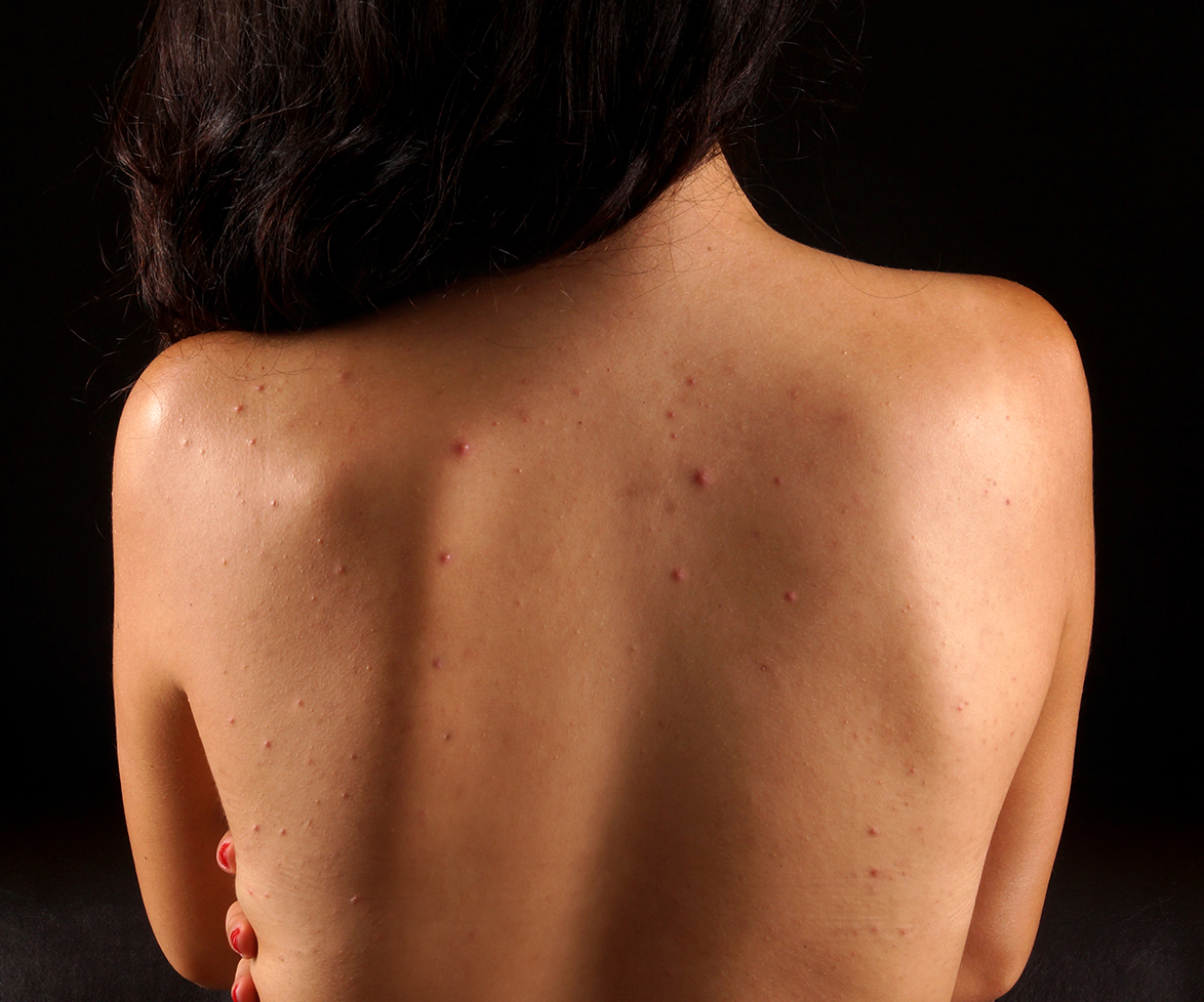 “The last thing that I thought would affect me was acne. I was very wrong.”