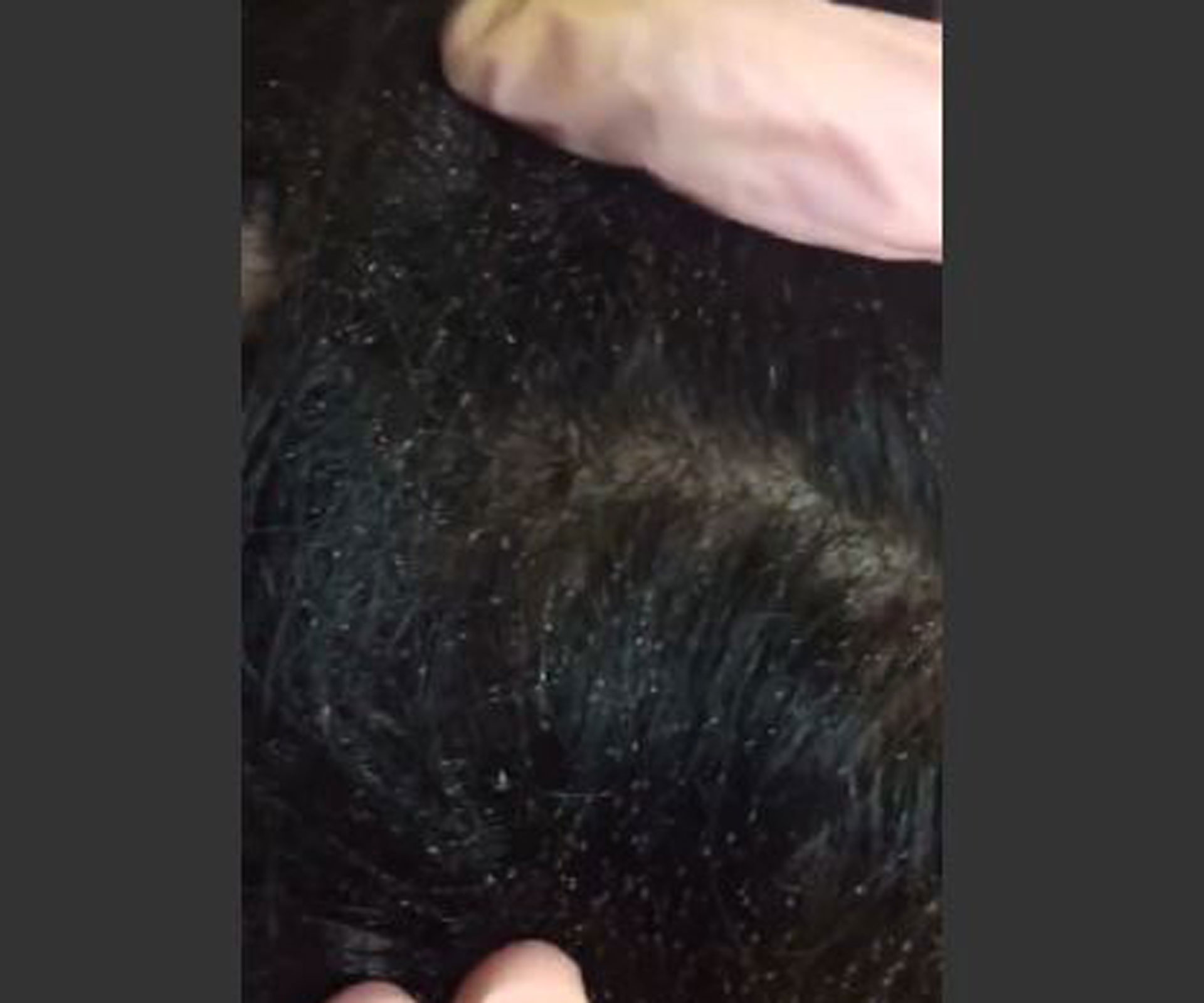 WATCH: Is this the worst case of head lice you’ve ever seen?
