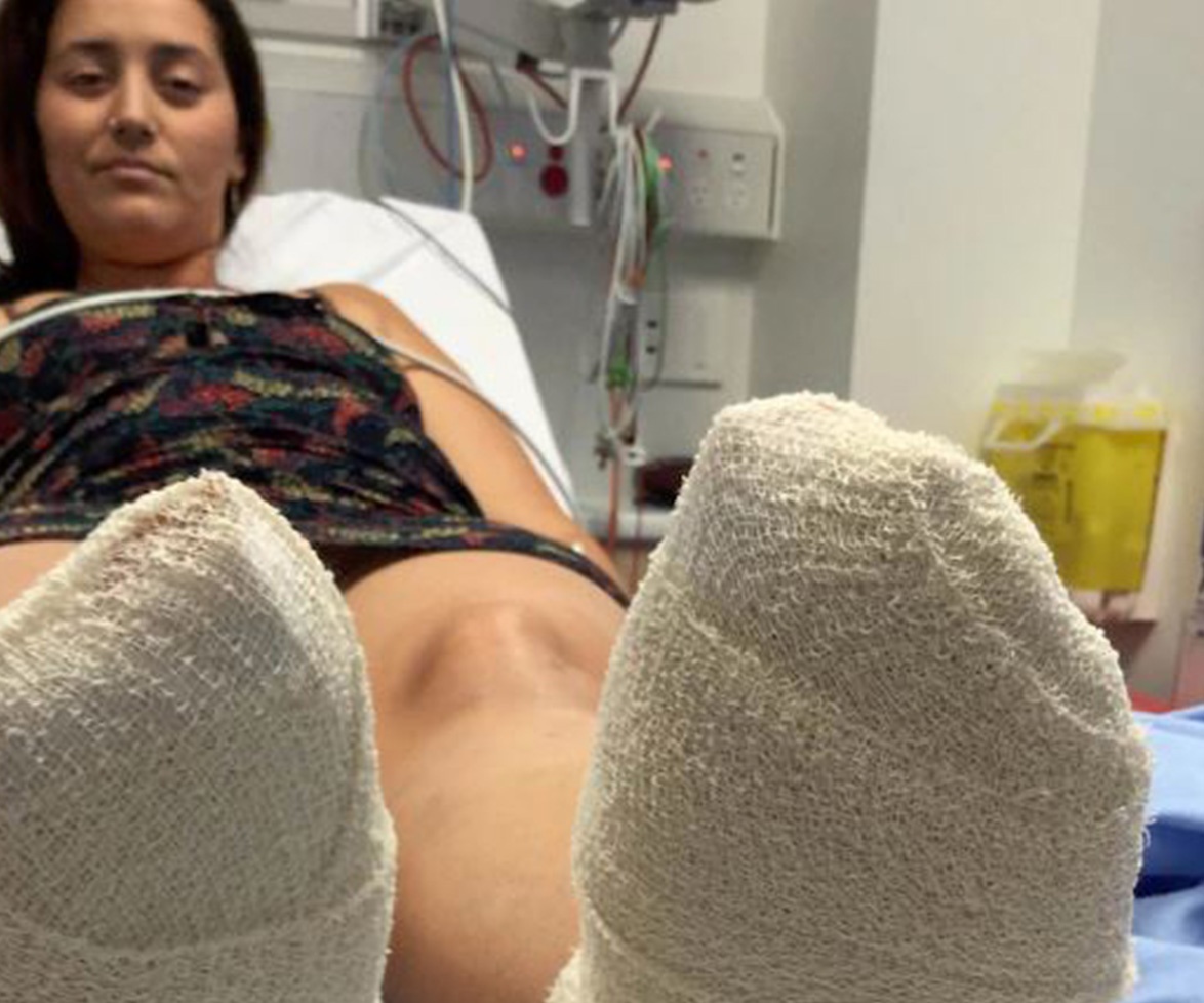Woman walks on hot sand at beach, admitted to the burns unit with severely blistered feet