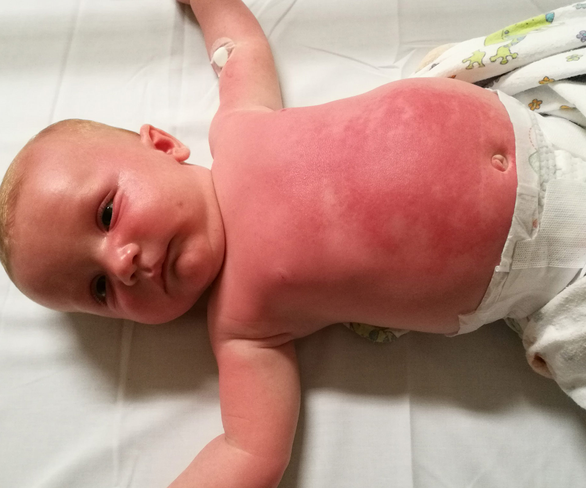 Baby hospitalised after reaction to Cancer Council Peppa Pig sunscreen