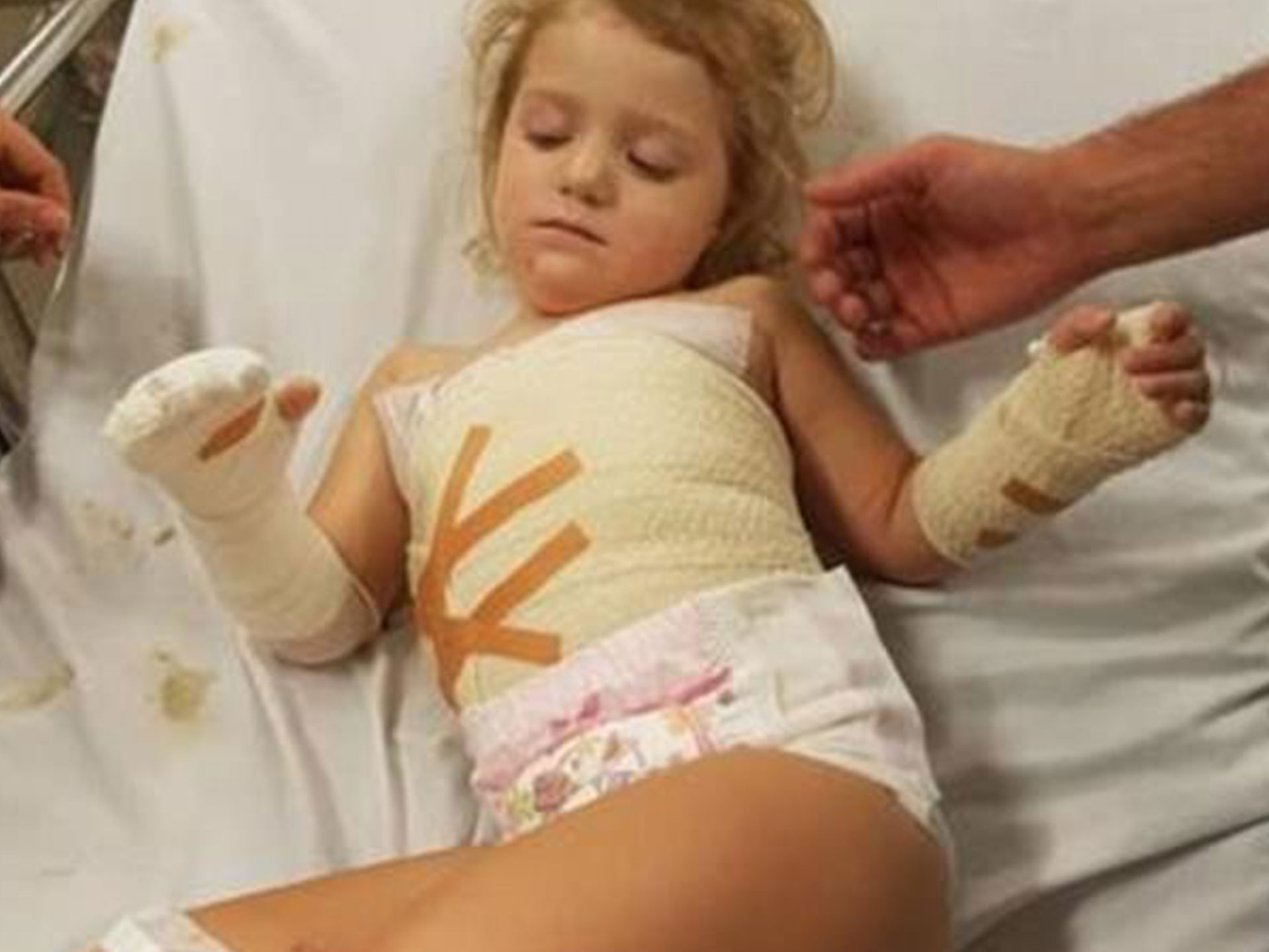 A three-year-old has been forced to get skin grafts after horrific treadmill accident