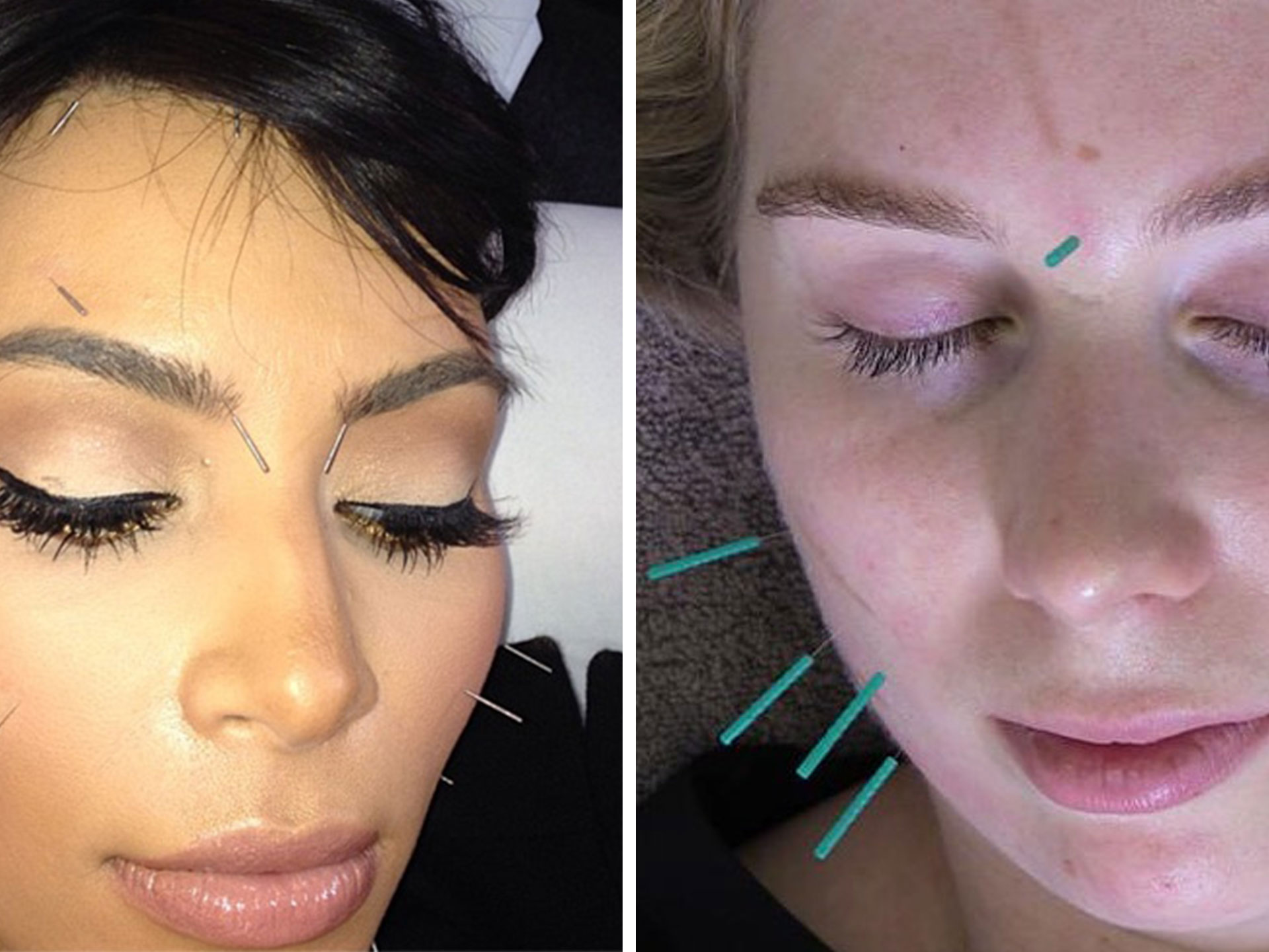 facial rejuvenation cosmetic acupuncture review Kim Kardashian