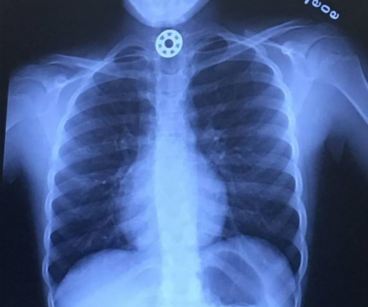 A young girl is lucky to be alive after her fidget spinner got stuck in her throat (!!!)
