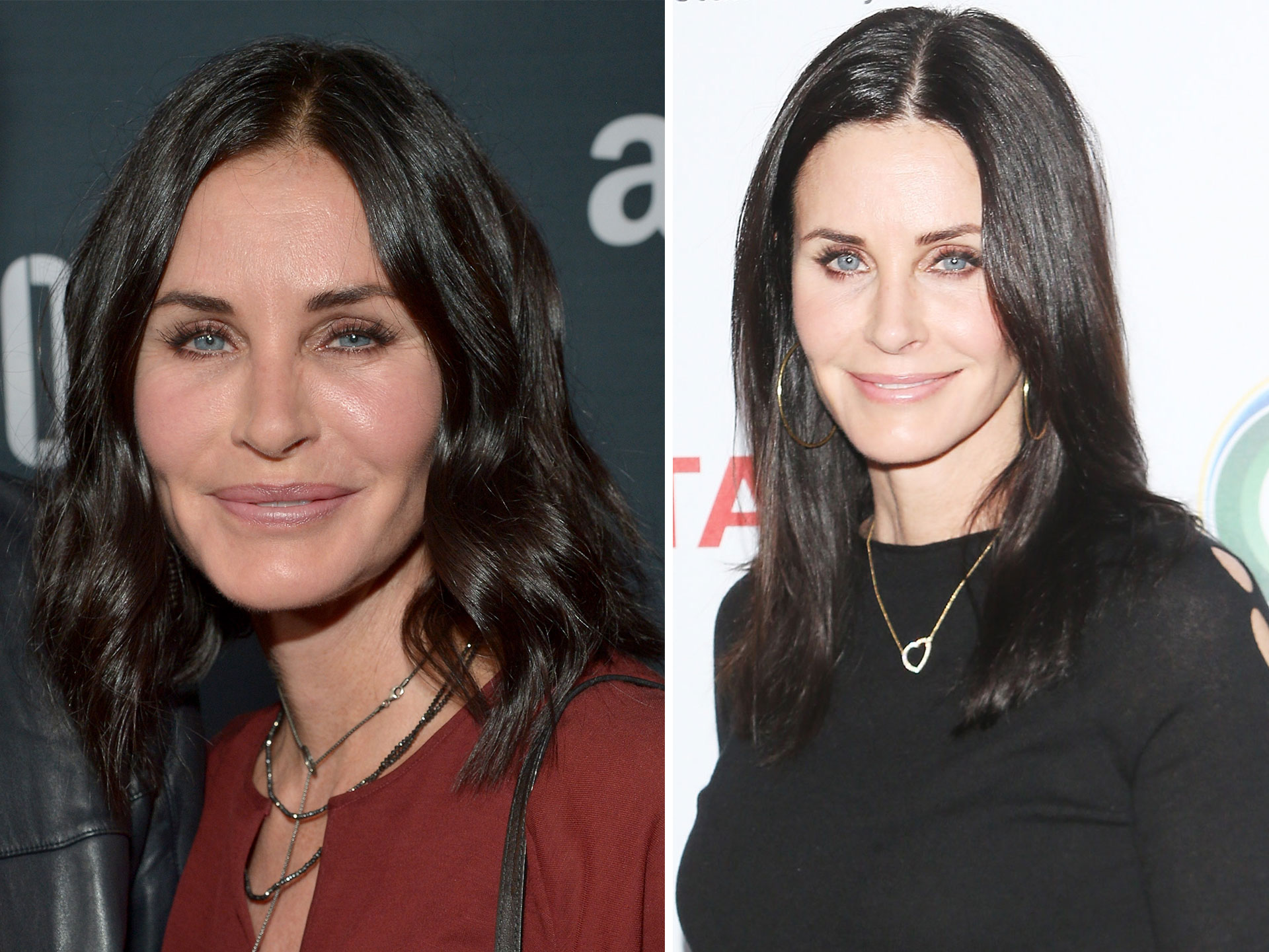Courteney Cox got her fillers and Botox dissolved