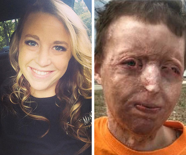 A woman was abandoned by her husband after she was disfigured by a fire he started