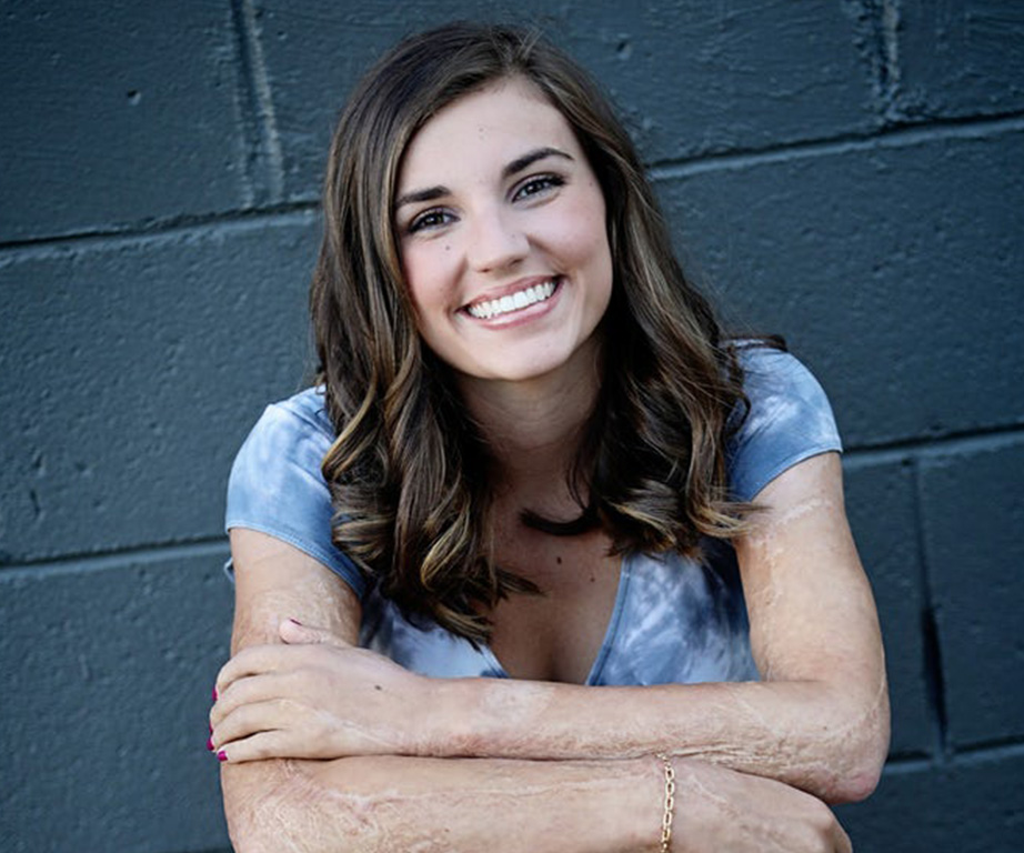 19-year-old burns survivor, Kilee Brookbank shares her inspiring story of recovery