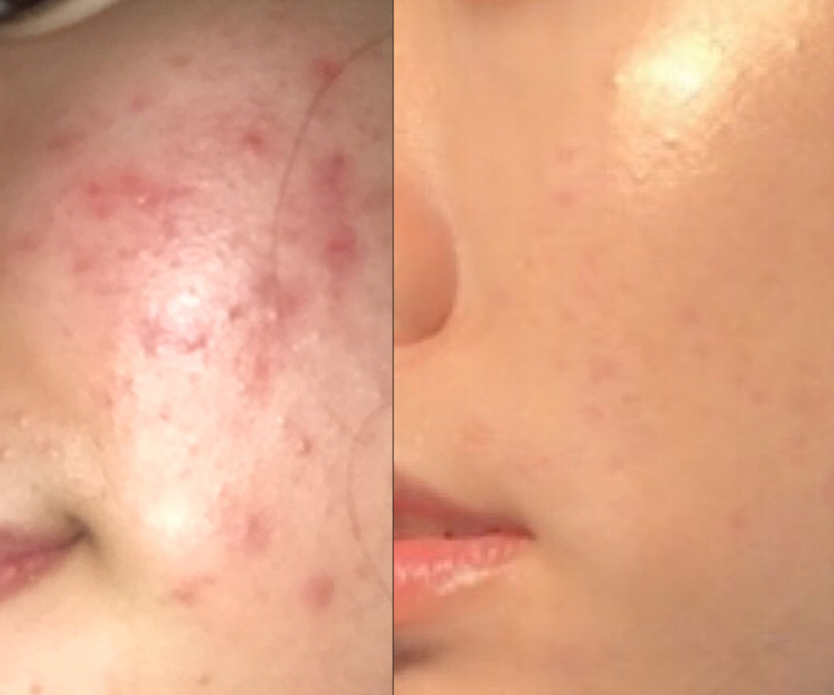 This woman cleared her acne on her own and now her skincare routine has gone VIRAL