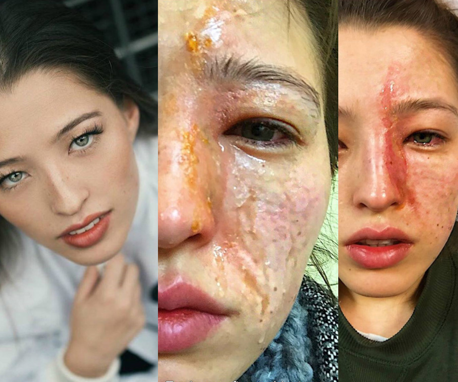 woman's face burnt by essential oil disffuser vapour