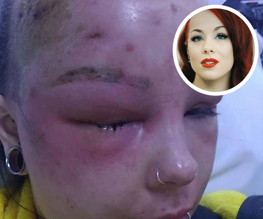 Young woman suffers irreversible damage after a routine body wax causes a severe skin infection