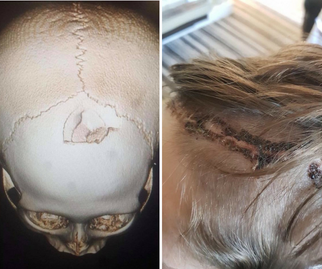 Images of skull xray and boys head stitche dup after bike accident