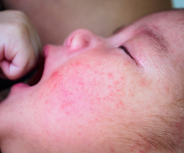 Eczema in children: How to relieve their painful itching