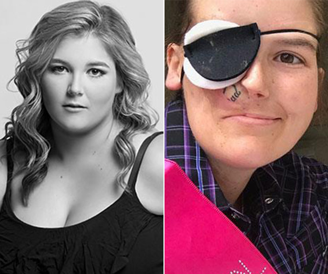 REAL LIFE: I lost half my face to cancer, but it didn’t stop me from living my dreams