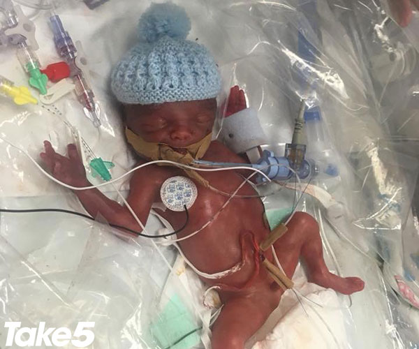 REAL LIFE: Doctors put my premature newborn in a plastic bag
