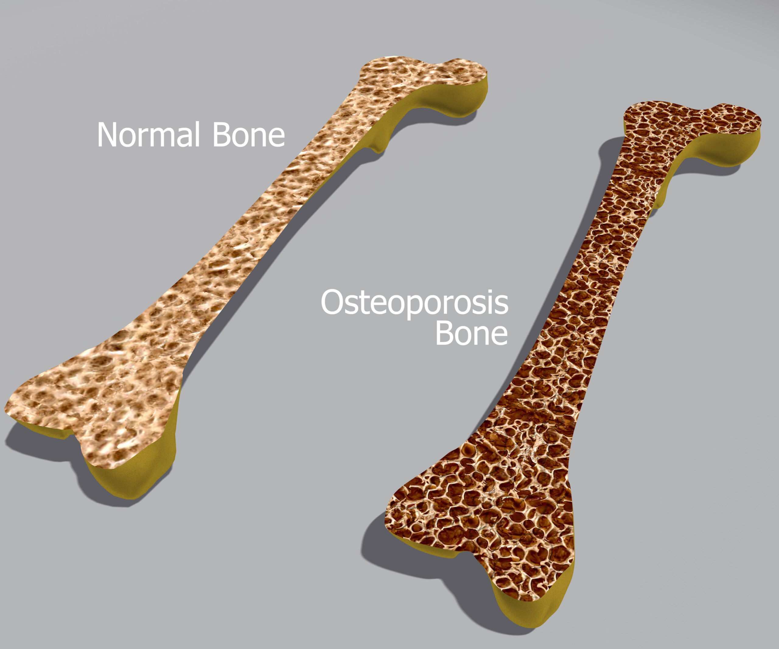 Coping with osteoporosis: Are you doing enough to protect your bones?