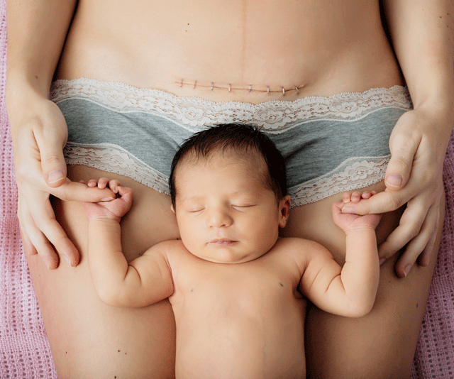 Do caesarean sections cause autism or ADHD?