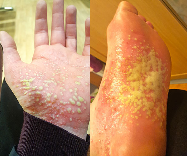 Real life: My psoriasis made my skin fall off and was so painful I couldn’t walk