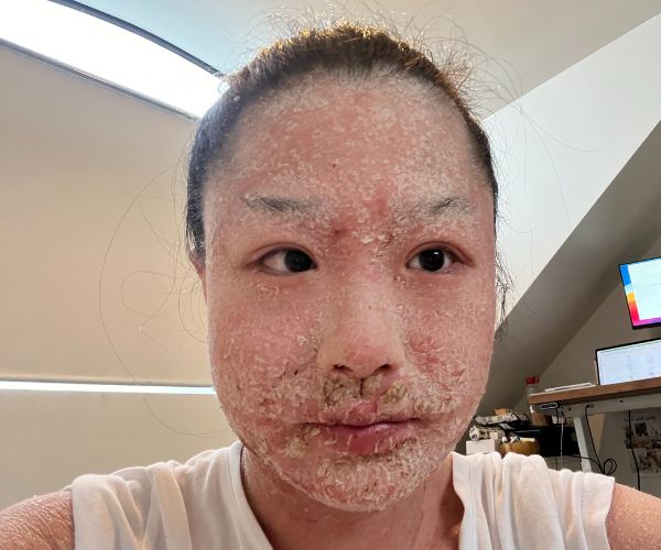 After spending a lifetime covered in cream, this brave eczema sufferer decided enough was enough