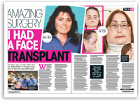Amazing surgery: I had a face transplant